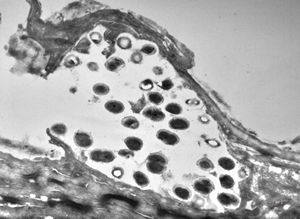 M, 60y. | otitis externa … microbes (fungi?) on the epidermal surface